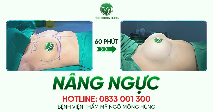 SAU KHI NÂNG NGỰC