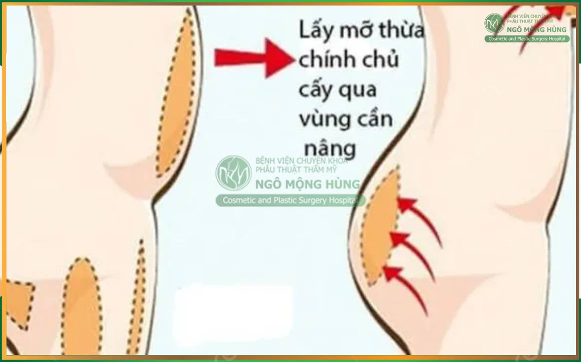 Hút mỡ cấy mông