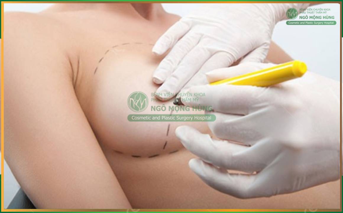 Bảng giá nâng ngực 2025