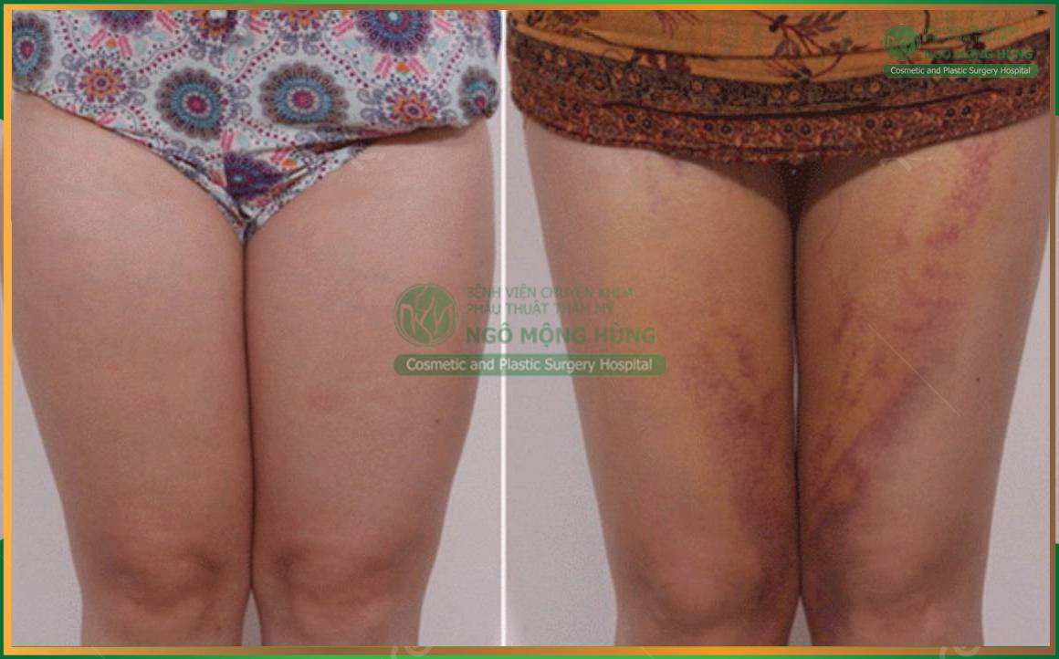 Biến chứng sau hút mỡ: Những điều chị em cần lưu ý