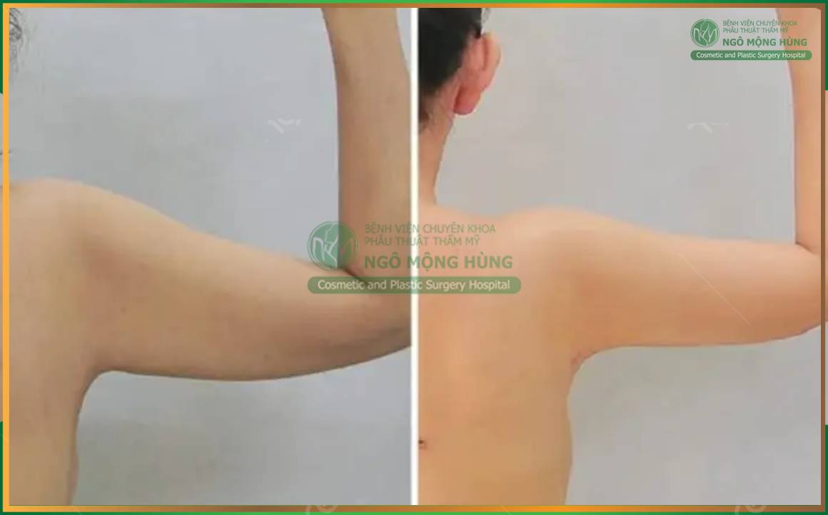 Hút mỡ bắp tay và vai