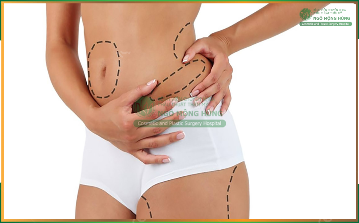 BV thẩm mỹ Ngô Mộng Hùng - Địa chỉ hút mỡ uy tín tại TPHCM