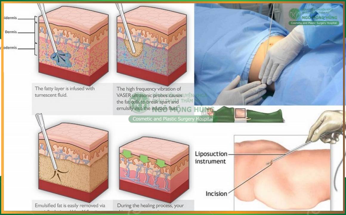Hút mỡ bụng có đau không