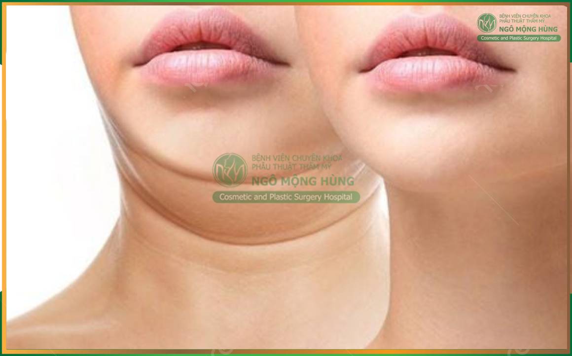 Hút mỡ nọng cằm và những điều bạn cần biết
