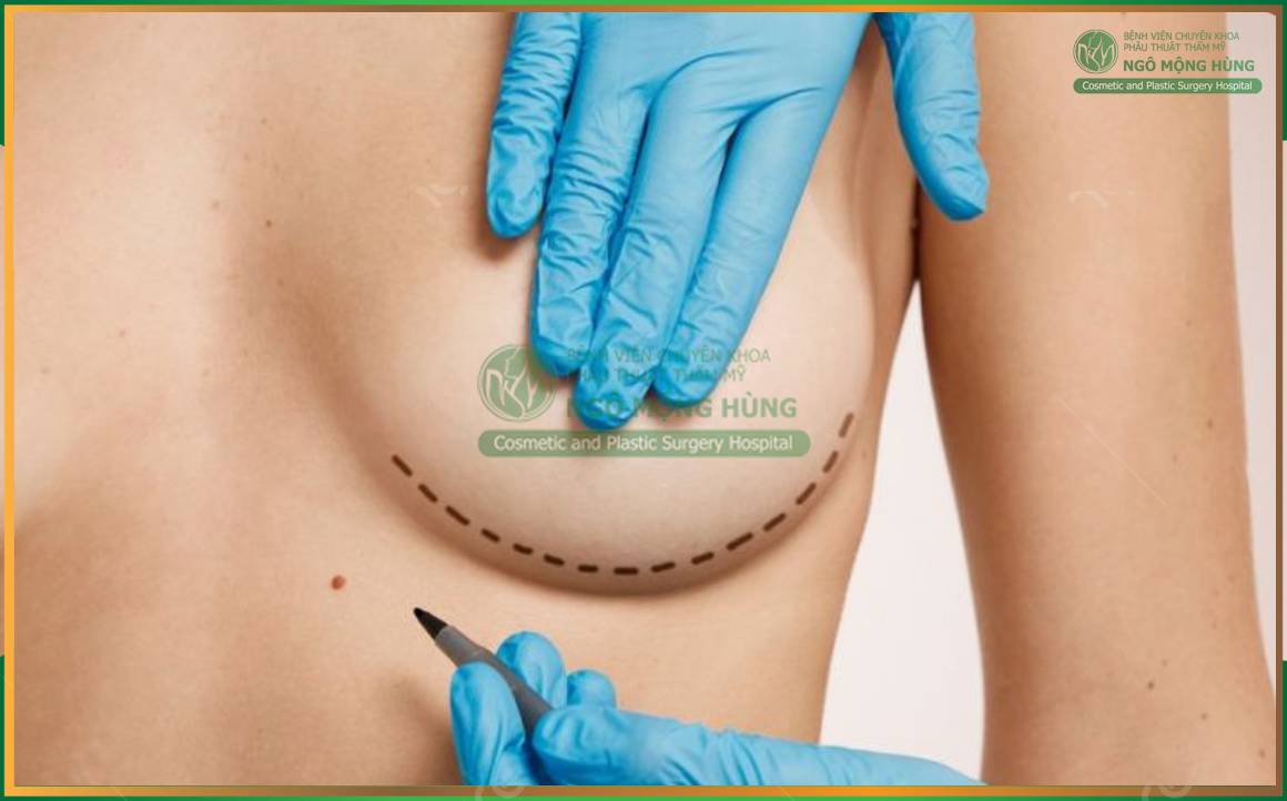 Bảng giá cùng khuyến mãi nâng ngực tại BV Thẩm Mỹ Ngô Mộng Hùng