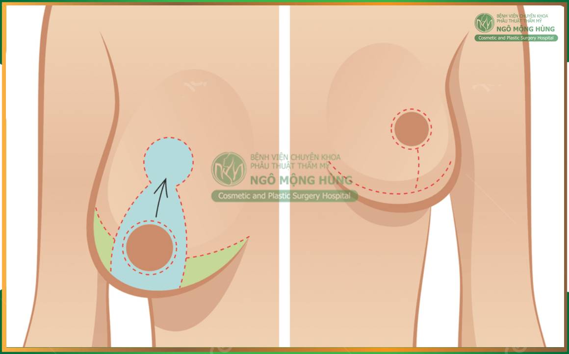 Nâng ngực chảy xệ: Giải pháp "cứu cánh" cho vòng 1 của chị em