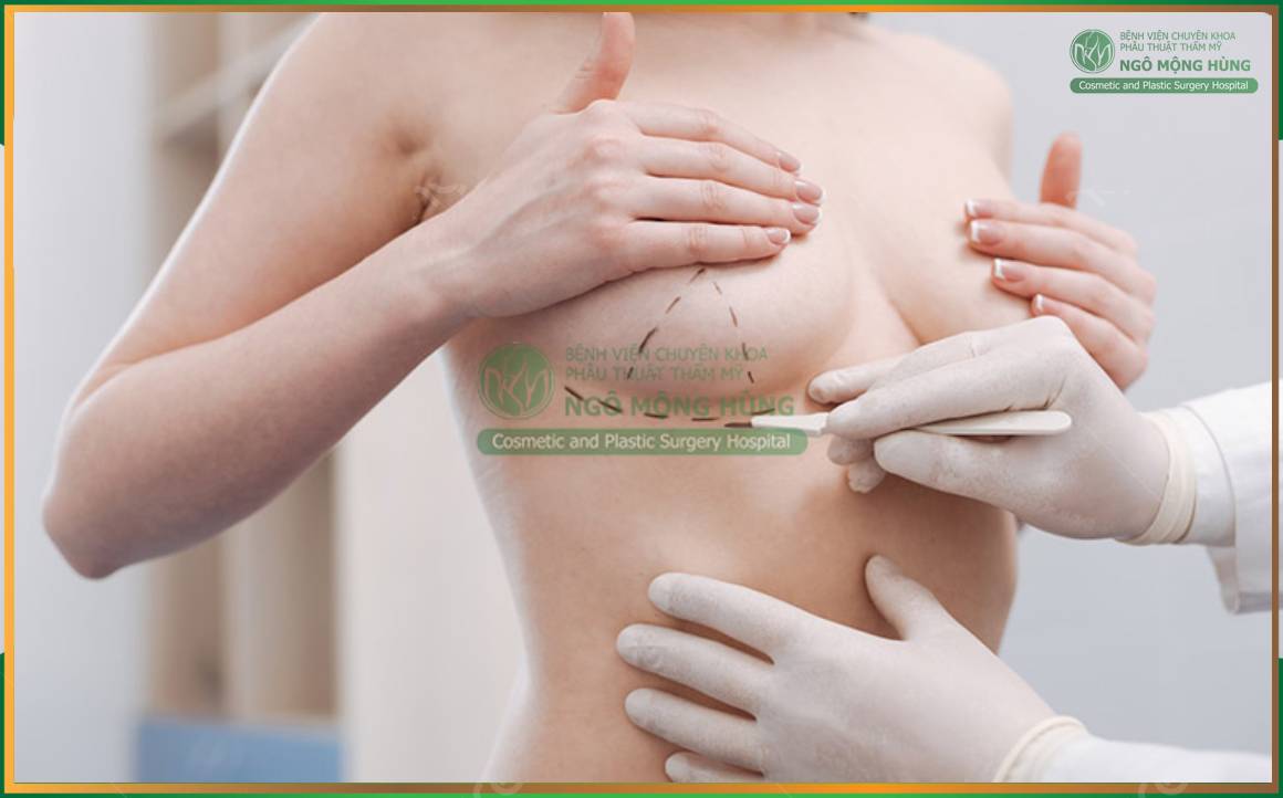 Giá nâng ngực bao nhiêu? 