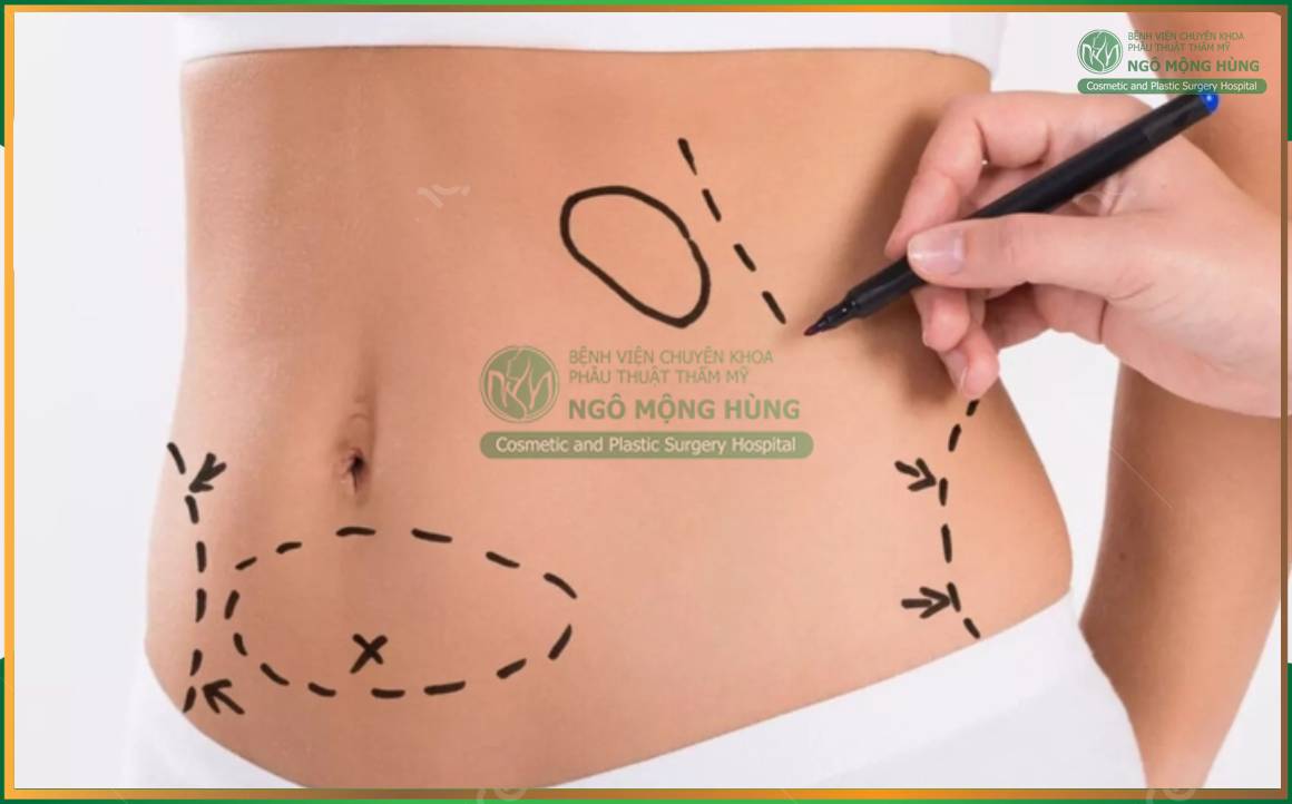 Quy trình hút mỡ chuẩn y khoa