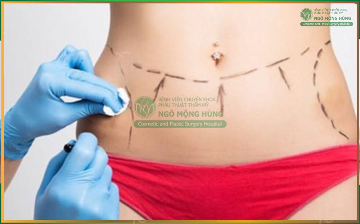 Review hút mỡ bụng Webtretho