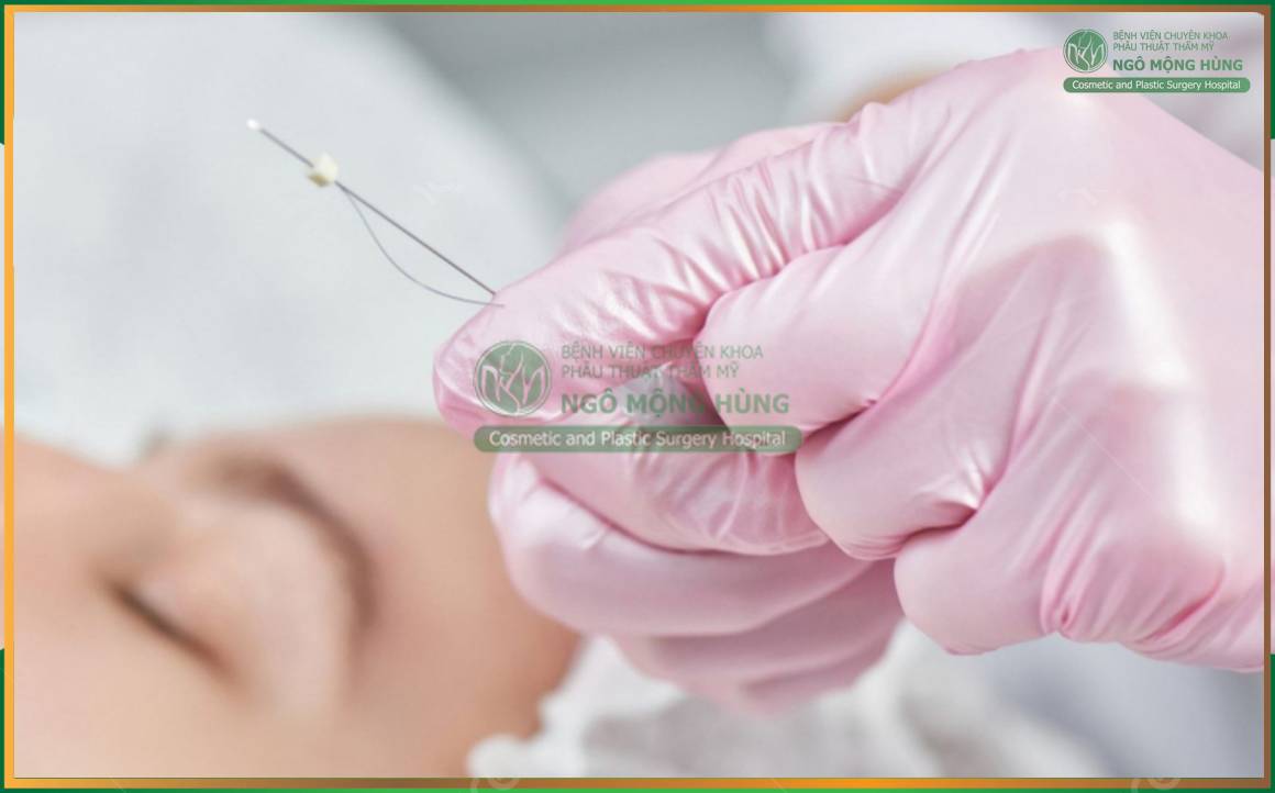 Nâng mũi bằng chỉ Collagen