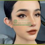 Nâng mũi cao tây (High Line): Sang chảnh, chuẩn góc nghiêng