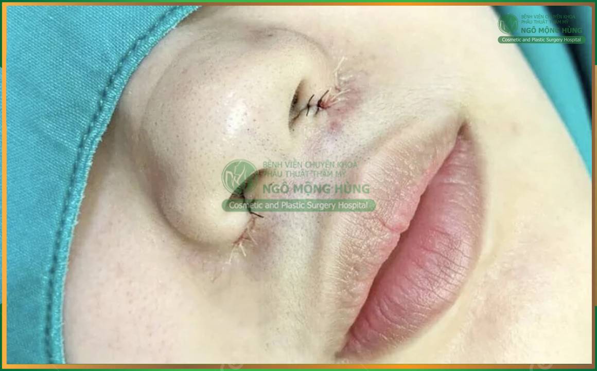 Nâng mũi có để lại sẹo không