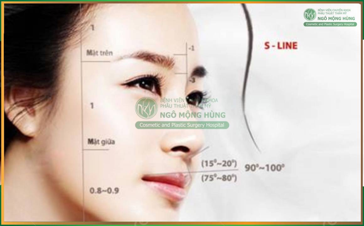 Nâng mũi dáng Trung Hoa