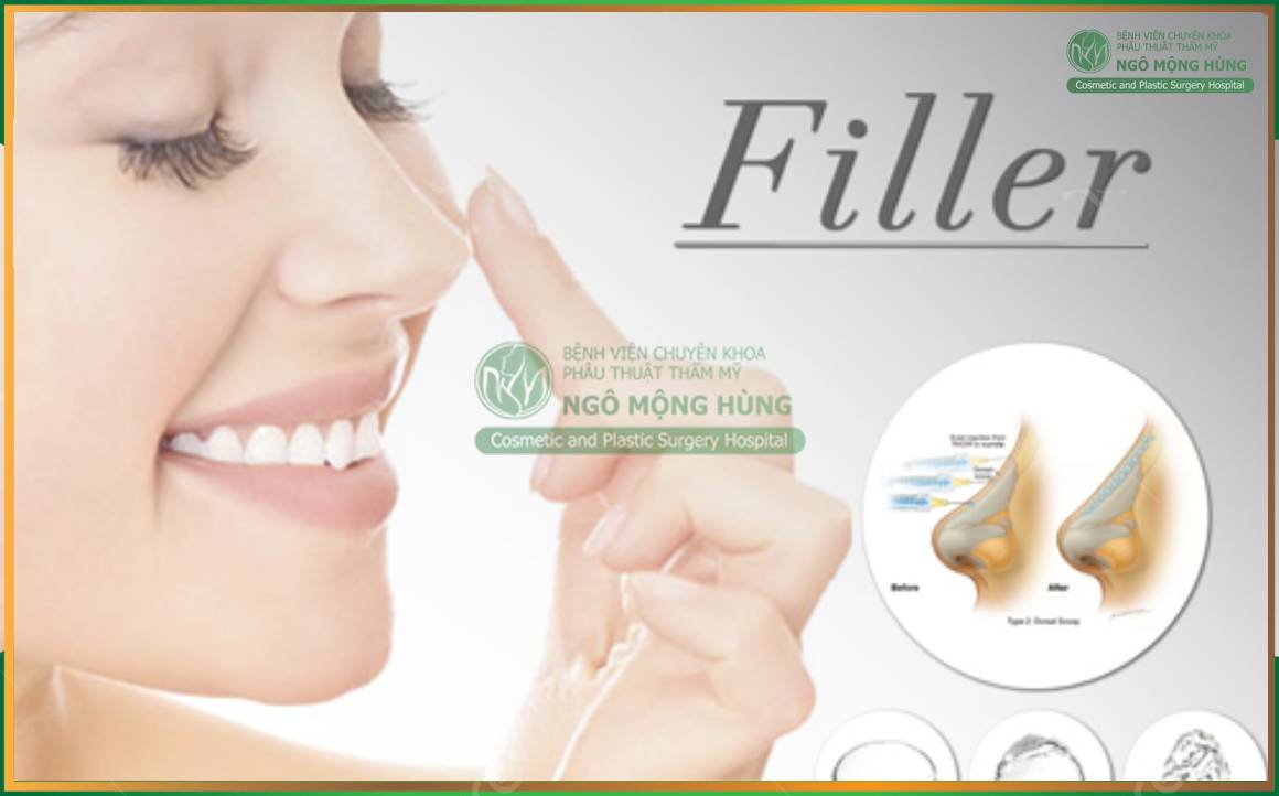 Nâng mũi không phẫu thuật