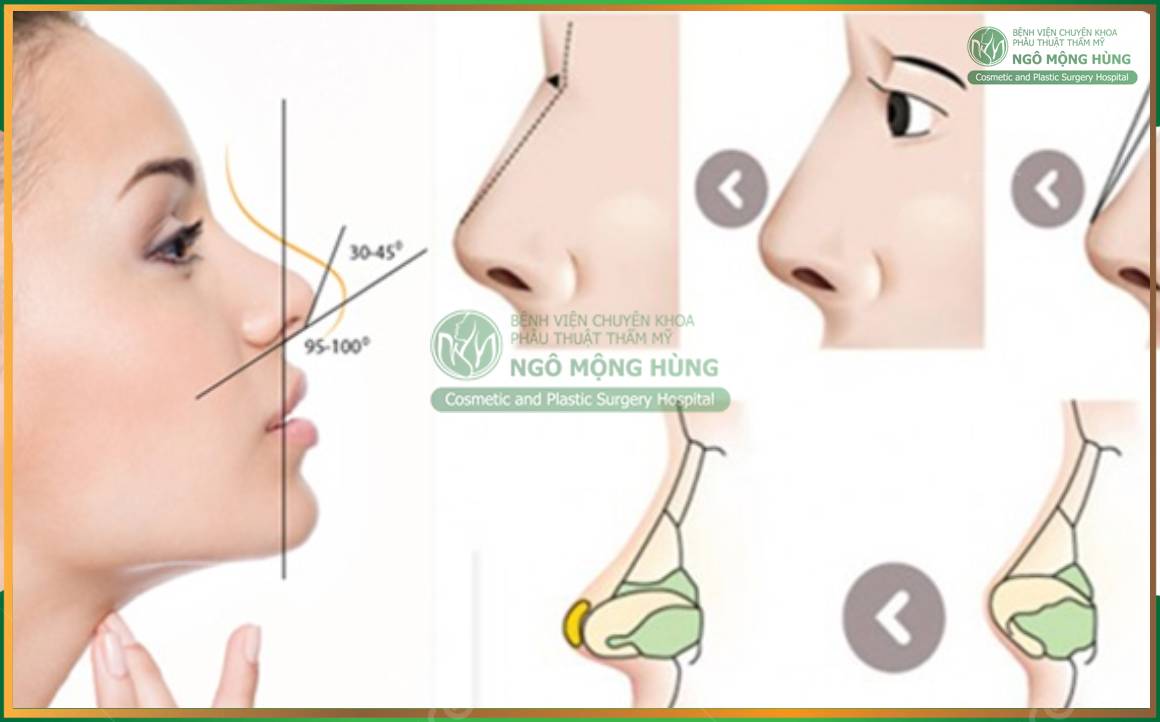 nâng mũi cấu trúc hay bọc sụn