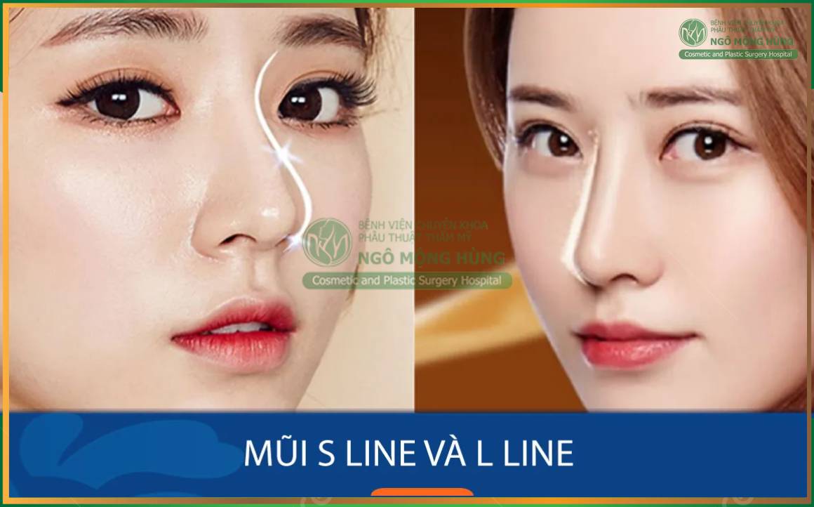 So sánh nâng mũi S Line và L Line