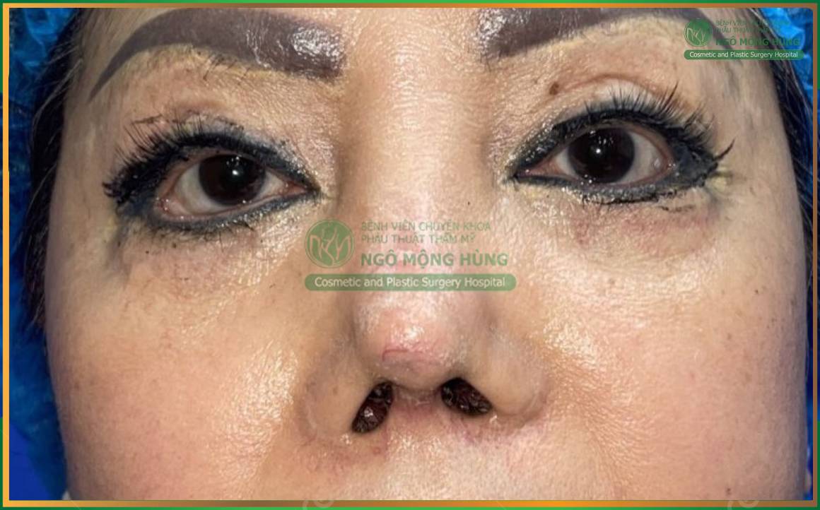 Biến chứng nâng mũi giá rẻ