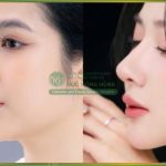 Chỉnh hình mũi gồ: Khắc phục tướng mũi xấu, trả lại đường thẳng