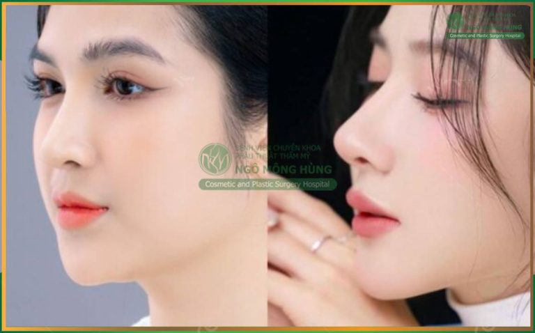 Chỉnh hình mũi gồ: Khắc phục tướng mũi xấu, trả lại đường thẳng