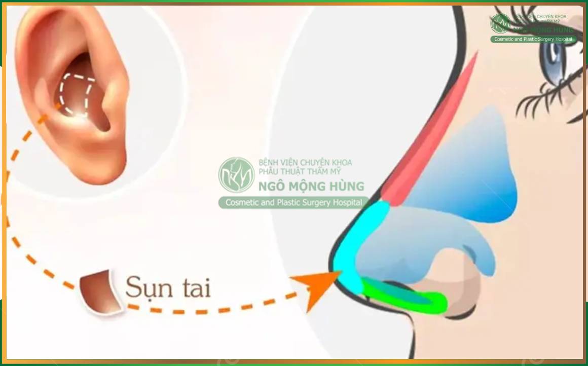 Giá nâng mũi bọc sụn tai