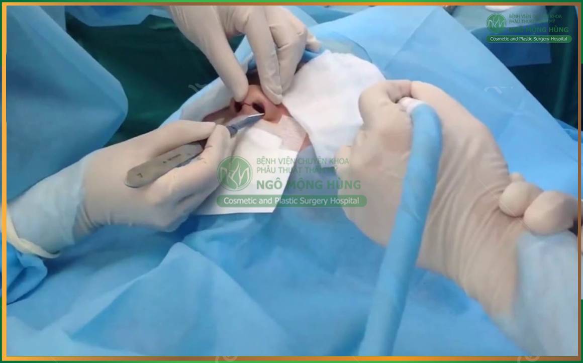 Nâng mũi S Line giá bao nhiêu?