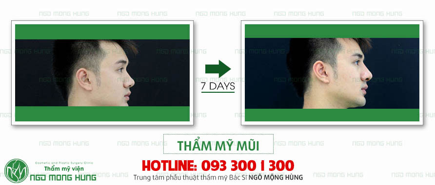 Hình ảnh trước sau khi nâng mũi 