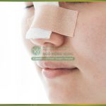 Mài gồ xương mũi: Kỹ thuật chỉnh xương giúp mũi thẳng tắp