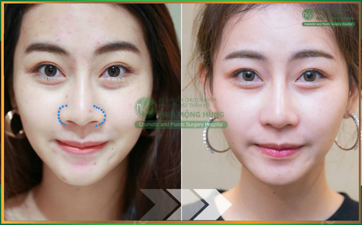 Bác sĩ Ngô Mộng Hùng nâng mũi có đẹp không