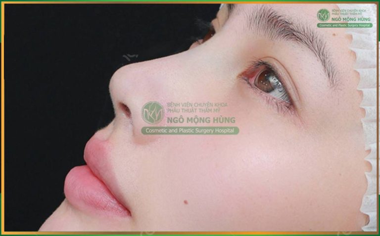 Giải pháp nâng mũi cho người da mỏng an toàn, hiệu quả