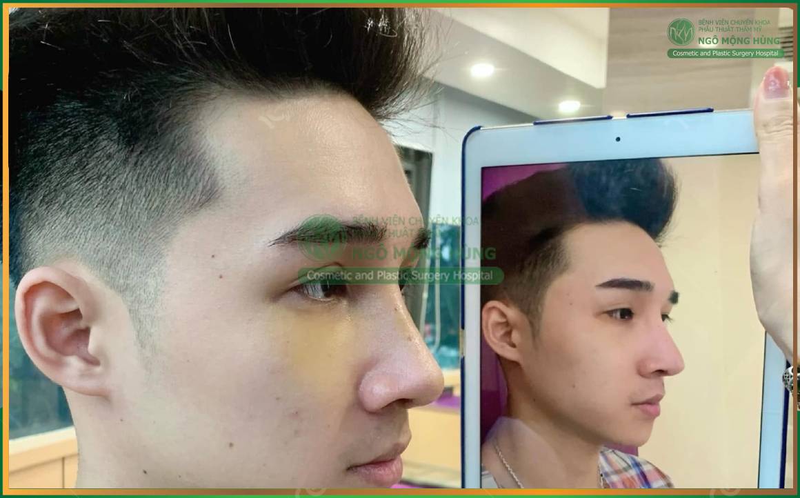 Nâng mũi nam giới L-Line: Mạnh mẽ, nam tính & phong độ