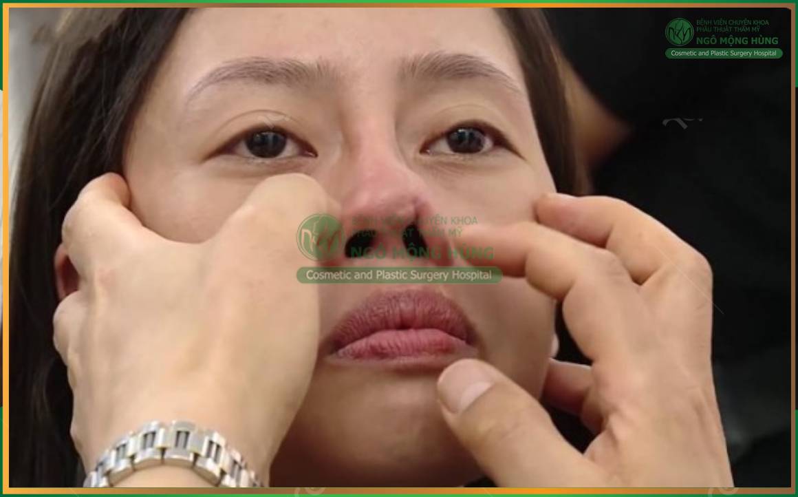 sửa mũi hỏng co rút